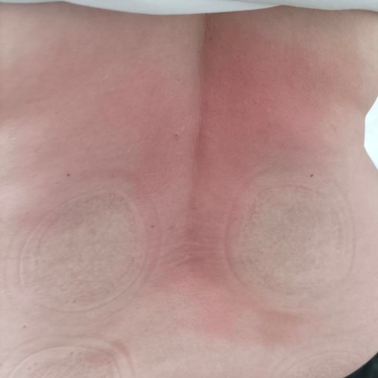 Fizik Tedavi Seansı Sonrası Yanık Ve Haksız Tedavi İptali Nedeniyle Mağduriyet