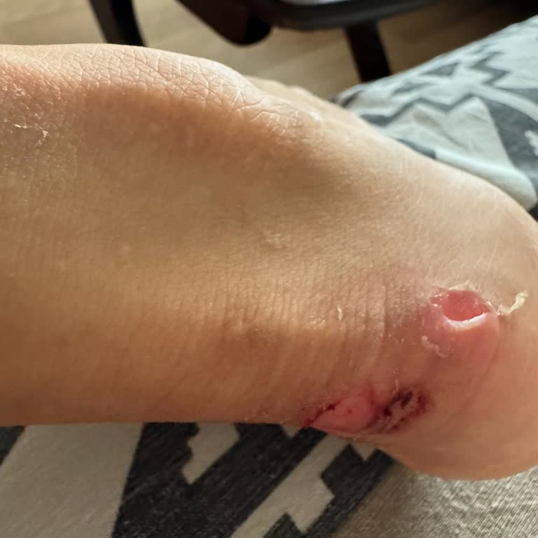 Aldığım Ayakkabı Ayağımı Yaraladı, Ücret İadesi Yapılmıyor