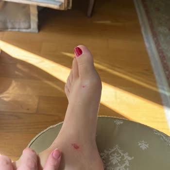 Birkenstock Terlik İlk Kullanımda Yara Yaptı Mağaza Çözüm Sunmadı