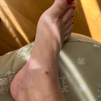 Birkenstock Terlik İlk Kullanımda Yara Yaptı Mağaza Çözüm Sunmadı