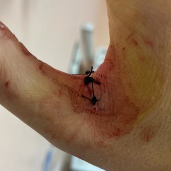 Marrakesh Alaçatı Otel Duş Kabininden Çıkarken Cam Aniden Kırıldı Ve Ellerim Kesildi!