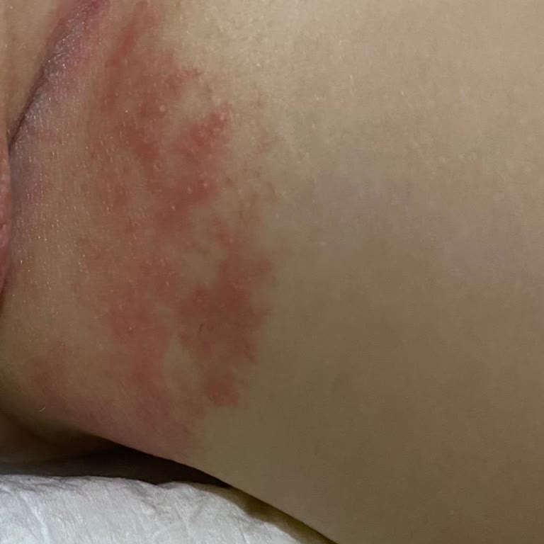 Yeni Sleepy Bez Paketi Bebeğimde Ciddi Pişik Ve Mantar Yaptı