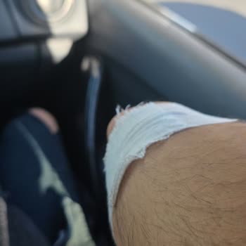 Yeni Alınan Scooterın Arızaları Ve Mağaza İlgisizliği Sonucu Yaşanan Kaza