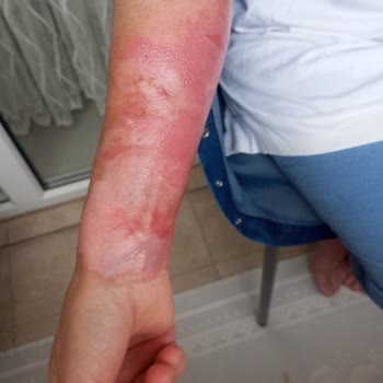 Patlayan Düdüklü Tencere Sonrası İlgisiz İnceleme Ve Kırık İade Mağduriyeti