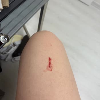 Lazer Epilasyon Sonrası Bacağımda Yanık Oluştu Kurumdan Çözüm Alamadım