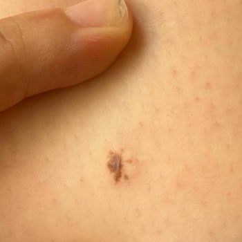 Lazer Epilasyon Sonrası Bacağımda Yanık Oluştu Kurumdan Çözüm Alamadım