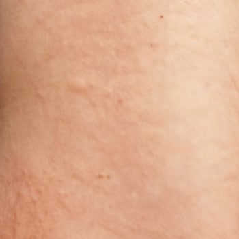 Bingo Lovely Yumuşatıcı Cildimde Alerjik Reaksiyona Sebep Oldu