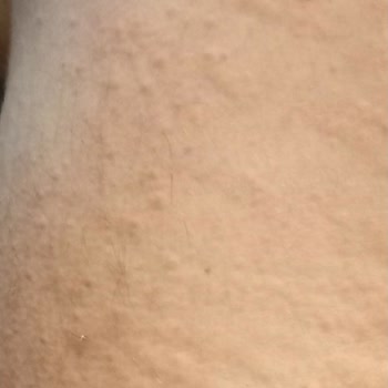 Bingo Lovely Yumuşatıcı Cildimde Alerjik Reaksiyona Sebep Oldu