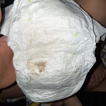 Bebek Bezlerinde Küf Benzeri Sorun Ve Sağlık Endişesi