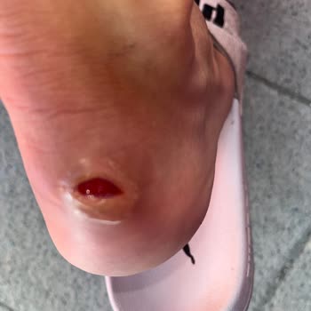 Kısa Sürede Rahatsızlık Veren Krampon İçin İade Talebim Reddedildi