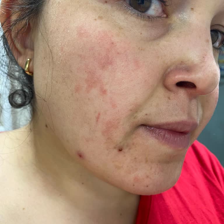 Alerjik Reaksiyona Neden Olan Krem İçin İade Talebim Reddedildi