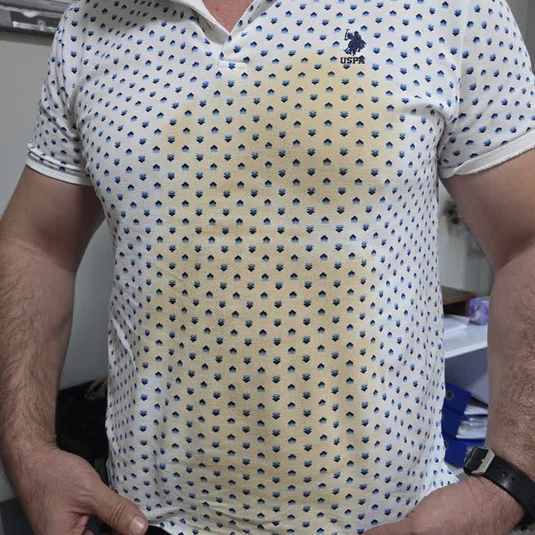 Starbucks'tan Aldığım Kahvenin Bardak Hatası Nedeniyle Yanık Oluştu