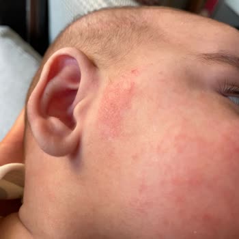 Mustela Ürünleri Çocuğumun Cildinde Sorunlara Yol Açtı