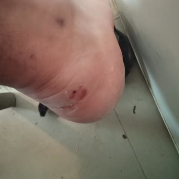 Kısa Sürede Yırtılan Ayakkabı Ve Yetersiz Müşteri Hizmeti Mağduriyeti