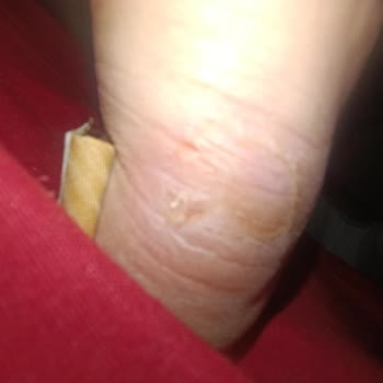 Kinetix Ayakkabı Ciddi Sağlık Sorunlarına Yol Açtı, FLO Ve Kinetix Sorumluluk Almadı