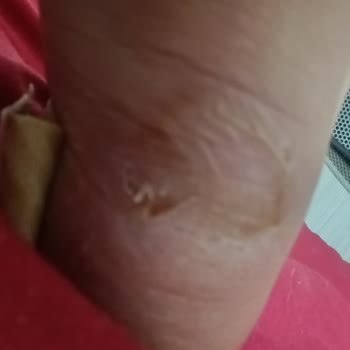 Kinetix Ayakkabı Ciddi Ayak Yaralanmalarına Sebep Oldu, Mağaza Ve Marka Çözüm Sunmadı