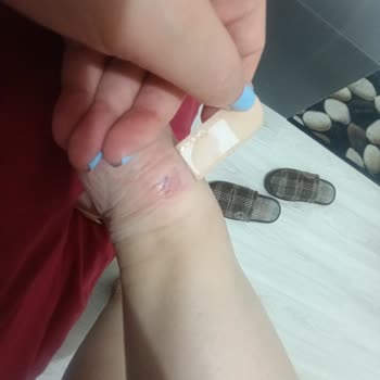 Kinetix Ayakkabı Ciddi Ayak Yaralanmalarına Sebep Oldu, Mağaza Ve Marka Çözüm Sunmadı