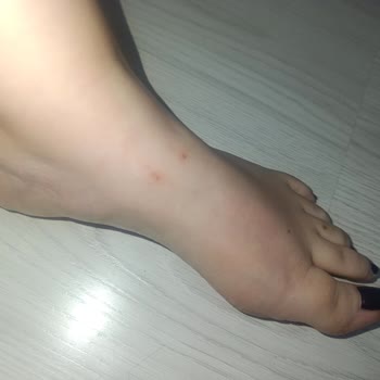 Kinetix Ayakkabı Ciddi Ayak Yaralanmalarına Sebep Oldu, Mağaza Ve Marka Çözüm Sunmadı