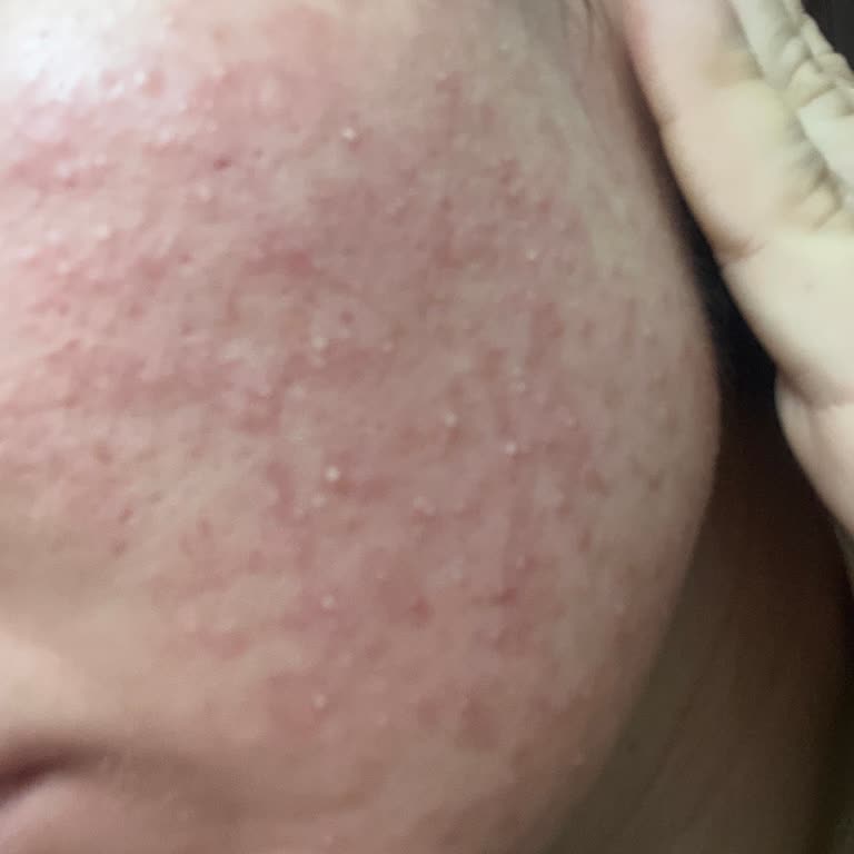 Cilt Temizleme Jeli Şiddetli Alerjiye Sebep Oldu, Acil İnceleme Gerekli!