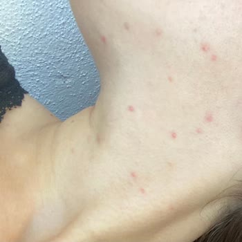 Garnier C Vitamini Güneş Kremi Sonrası Yüzümde Yoğun Döküntü Ve İzler Oluştu