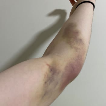 Türk Kızılay Kan Bağışı Sonrası Morarma Ve Yetersiz Bilgilendirme Nedeniyle Mağduriyet Yaşadım