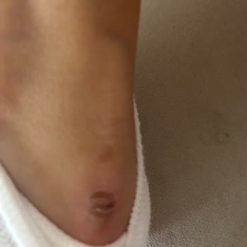 Yeni Alınan Ayakkabıda Topuk Sorunu Ve Rahatsızlık