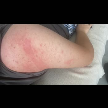 Mintax Yüzey Temizleyici Ciddi Alerjik Reaksiyona Sebep Oldu!