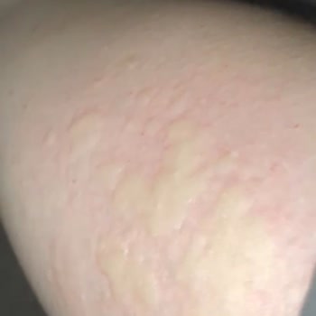 Mintax Yüzey Temizleyici Ciddi Alerjik Reaksiyona Sebep Oldu!