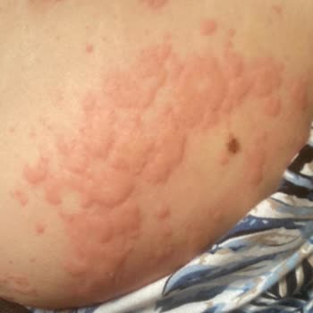 Mintax Yüzey Temizleyici Ciddi Alerjik Reaksiyona Sebep Oldu!