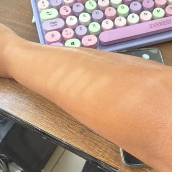 Lazer Epilasyon Sonrası Kalıcı İz Ve Çözüm Sunulmayan Mağduriyet