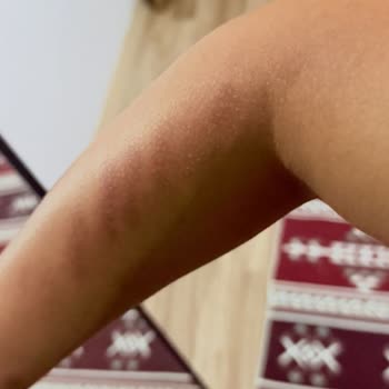 Lazer Epilasyon Sonrası Kalıcı İz Ve Çözüm Sunulmayan Mağduriyet