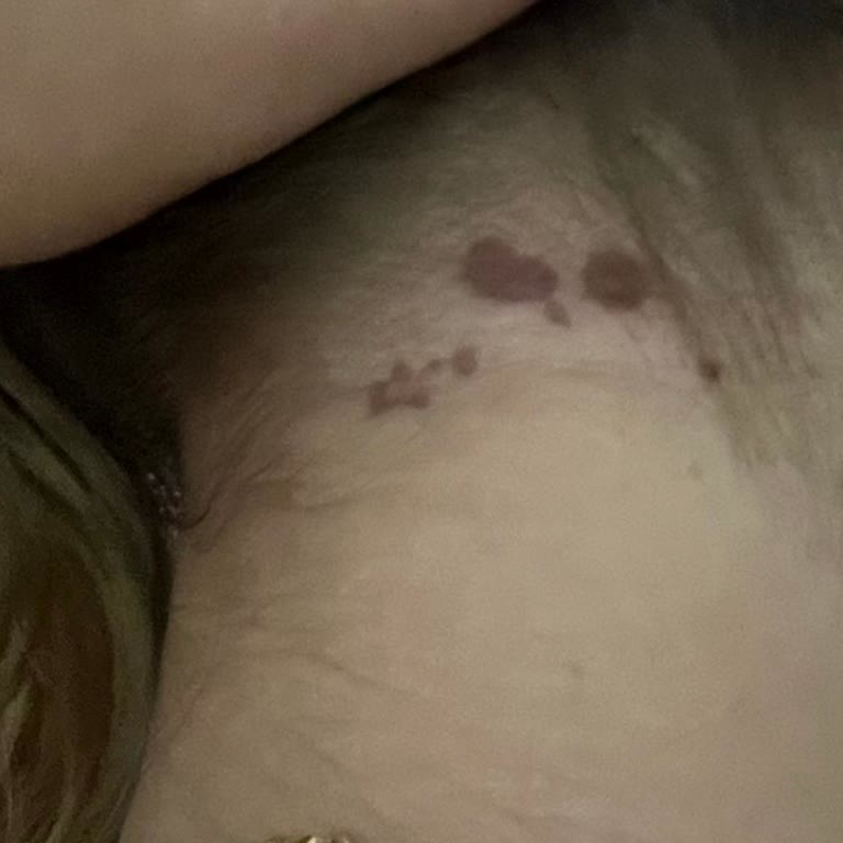 Saç Boyası Kullanımı Sonrası Ciltte Yaralar Ve Yanık Oluştu