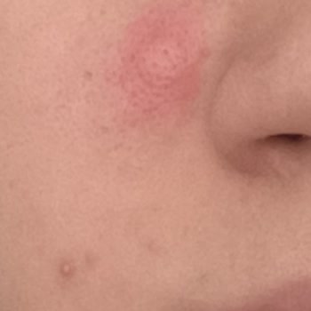 Krom Pikolinat Ürünü Ciddi Alerjik Reaksiyon Ve Sağlık Sorunu Yarattı