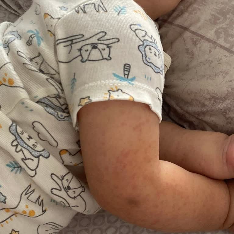 Uni Baby Sıvı Deterjan Sonrası Bebeğimde Ciddi Döküntüler Oluştu