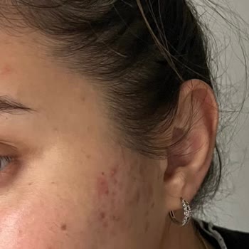 Hijyen Eksikliği Ve İlgisizlik Sonrası Cilt Sorunları