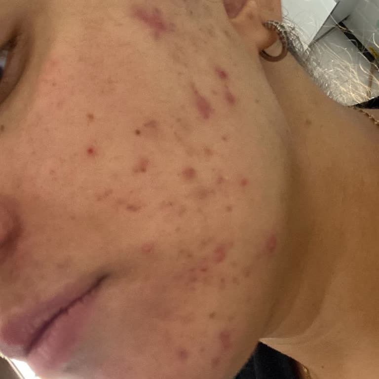 Verilen Sözler Tutulmadı, Cilt Sorunum Daha Da Kötüleşti: Ücret İadesi Talebim Var