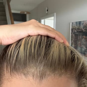 Saç Boyama Sonrası Yanmış Ve Kopmuş Saçlarla Büyük Hayal Kırıklığı