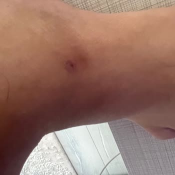 Aldığım Terlik Ayağımda Sürekli Yara Ve Acı Oluşturuyor