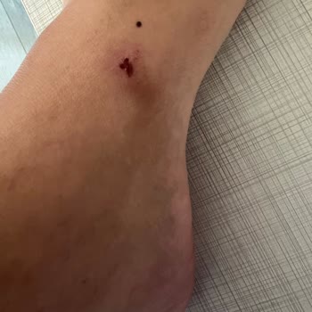 Aldığım Terlik Ayağımda Sürekli Yara Ve Acı Oluşturuyor