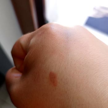 Seans Sonrası Cilt Yanıkları Ve İade Talebime Dönüş Yapılmıyor