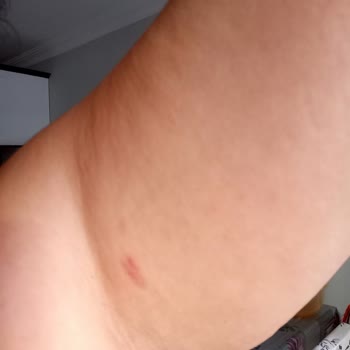 Seans Sonrası Cilt Yanıkları Ve İade Talebime Dönüş Yapılmıyor