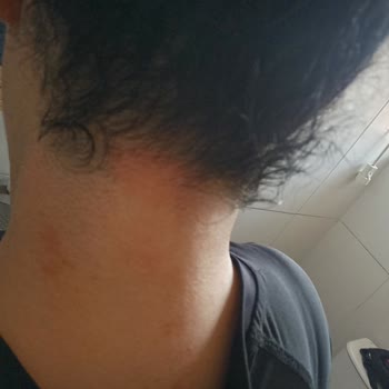 Seans Sonrası Cilt Yanıkları Ve İade Talebime Dönüş Yapılmıyor