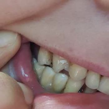 İmplant Tedavisi Sonrası Yaşanan Sağlık Sorunları Ve Mağduriyet