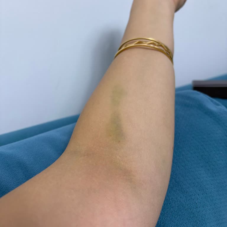 Natomed Hastanesi Yanlış Damar Yolu Açımı Sonrası Kolumda Ağrı ve Morarma Yaşadım