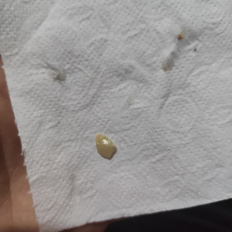 Patlamış Mısır Nedeniyle Dişim Kırıldı, Mağduriyetim Giderilsin!