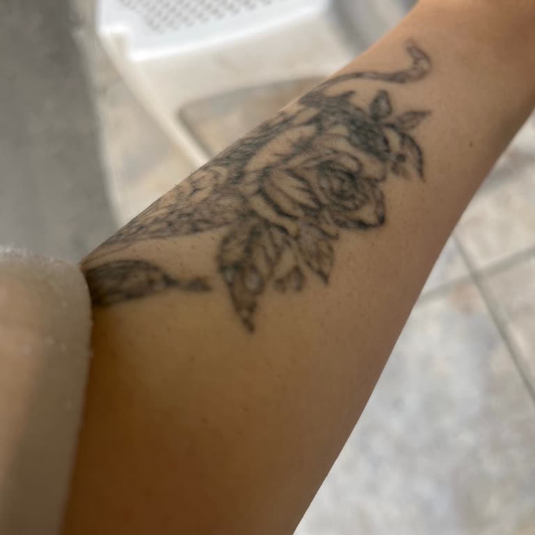 Orijinal Olmayan Cihazla Etkisiz Dövme Silme Ve Ücret İadesi Mağduriyeti