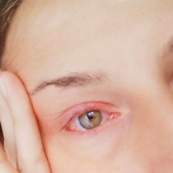 Bulaşık Makinesi Tableti Kazası: Göz Yaralanması Ve Güvenlik Endişesi