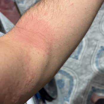 Dynavit B12 Vitamininde Alerjik Reaksiyon Ve Mağduriyet