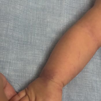 3 Aylık Bebeğimin Acilde Morarması: Güven Sarsıcı Müdahale