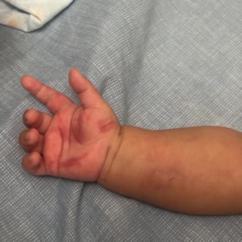 3 Aylık Bebeğimin Acilde Morarması: Güven Sarsıcı Müdahale